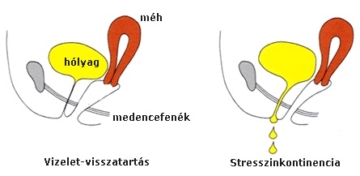 stressz-inkontinencia
